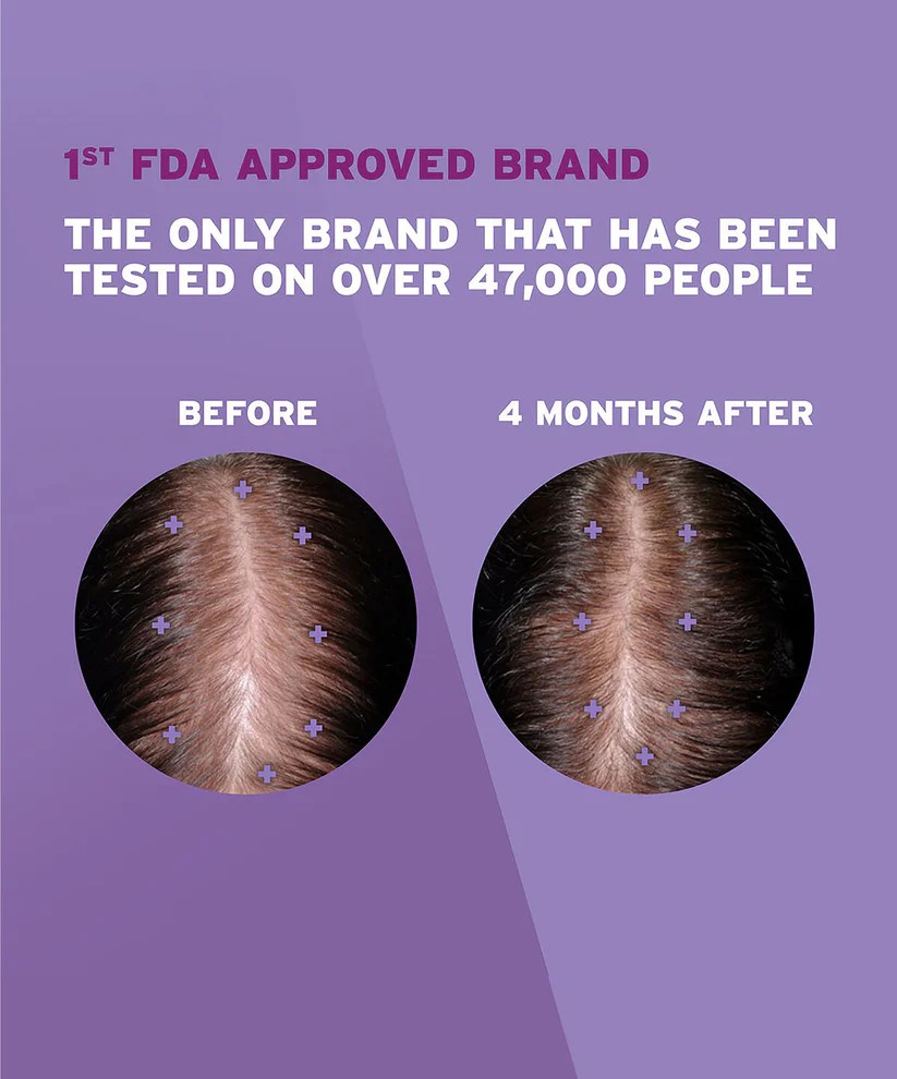 Rogaine 5% Minoxidil Foam Topical Loss Treatment ทรีทเมนต์โฟม ลดผมร่วง เพื่อให้ผมดูหนาขึ้น สำหรับผู้หญิง