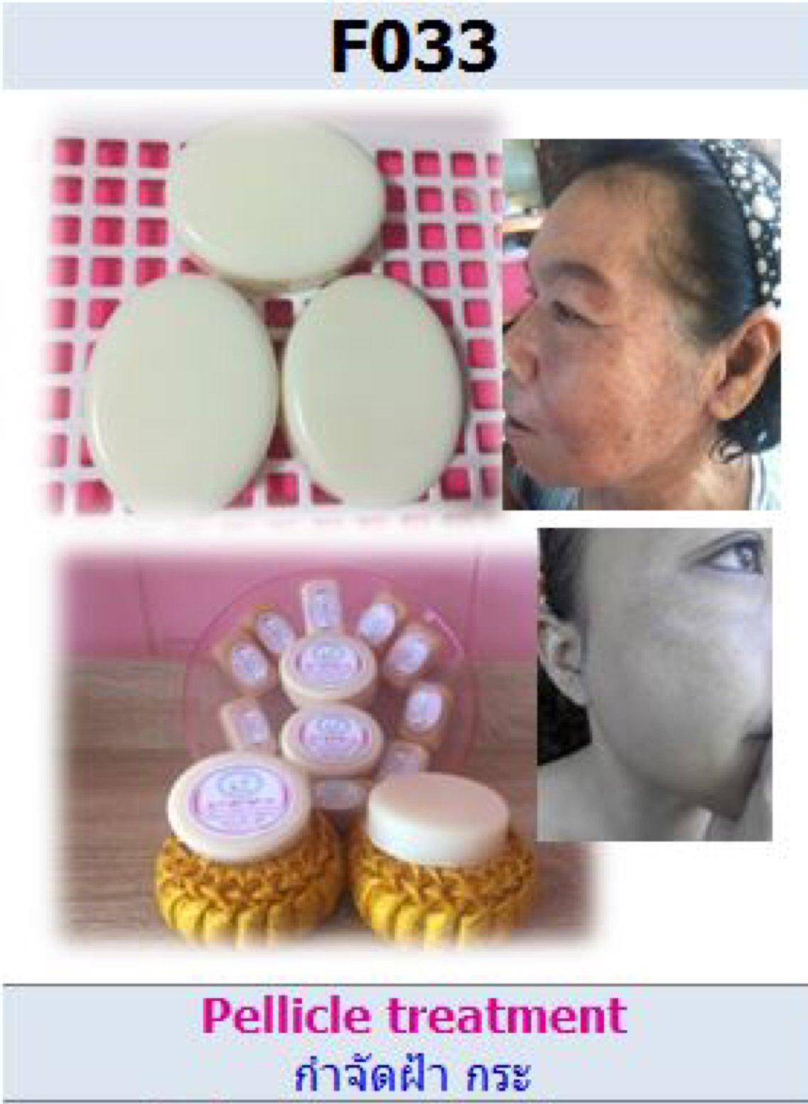 สบู่ GP สูตรกำจัดฝ้า กระ (Pellicle treatment)