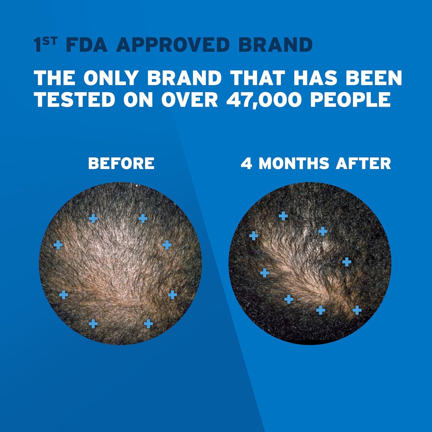 Rogaine 5% Minoxidil Topical Aerosol Hair Regrowth Treatment Foam ทรีทเมนต์โฟม ลดผมร่วง เพื่อให้ผมดูหนาขึ้น สำหรับผู้ชาย