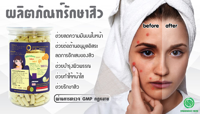 รักษาสิว