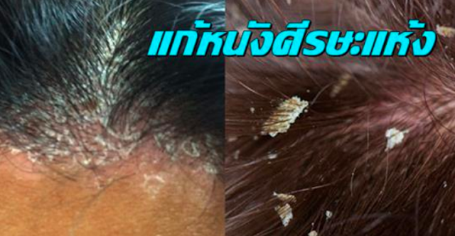 วิธีแก้ปัญหาหนังศีรษะแห้งแบบง่ายๆ และช่วยรักษาผมไม่ให้แห้งกร้าน