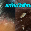 แจก 3 วิธีแก้ปัญหาหนังศีรษะแห้งแบบง่ายๆ และช่วยรักษาผมไม่ให้แห้งกร้าน